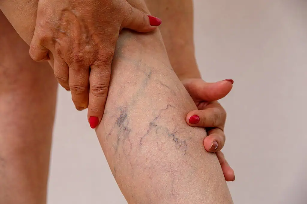 Photo of varicose veins